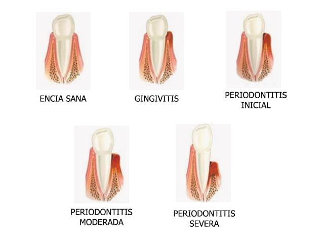 Periodoncia dental