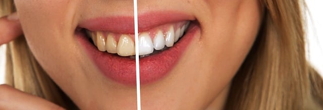 Blanqueamiento dental